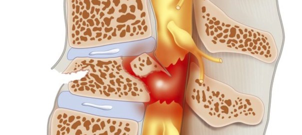 spinal cord injury stem cells PRP